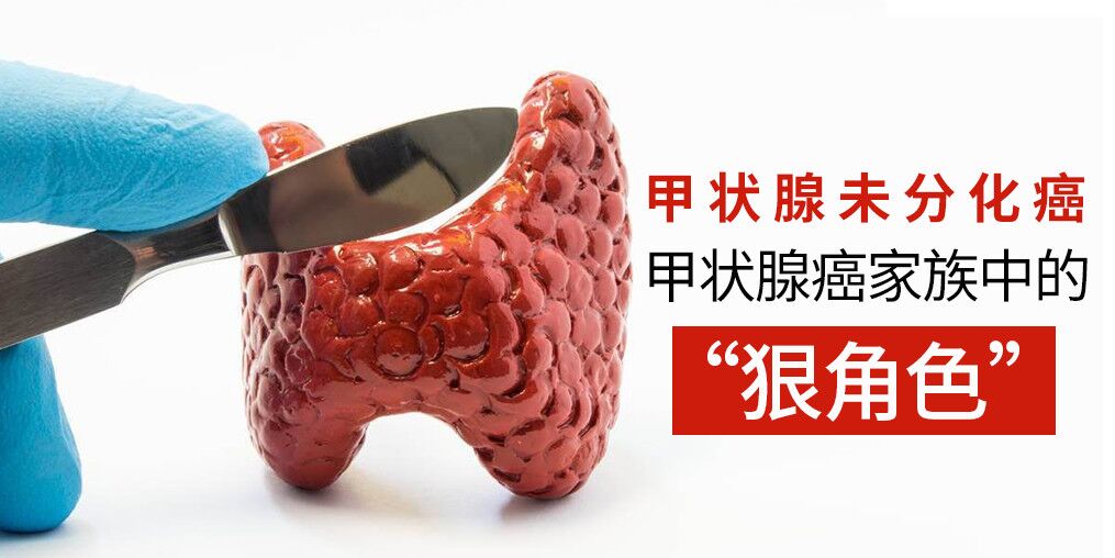 別忽視甲狀腺癌，它的家族也有“狠角色”