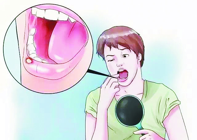 口腔潰瘍不是只需要補(bǔ)充維生素C，它們也是必不可少